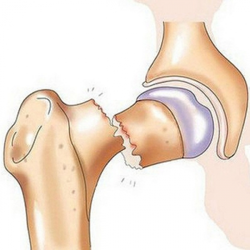 Найбільш поширені причини перелому шийки стегна